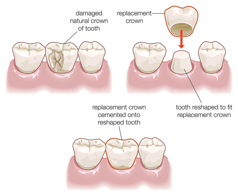dental crown procedure illustration c33196 768x632