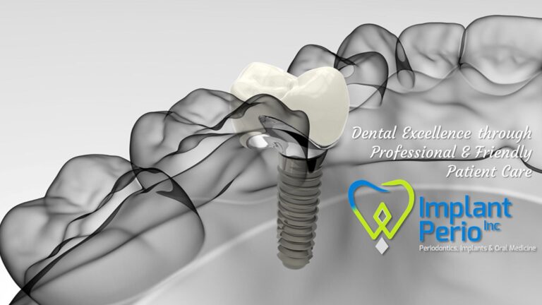 Implant Perio hero image 768x432