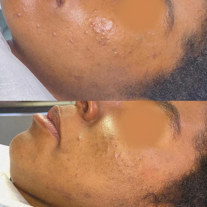 acne 700