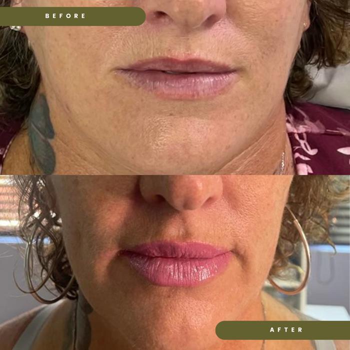 lip filler 700