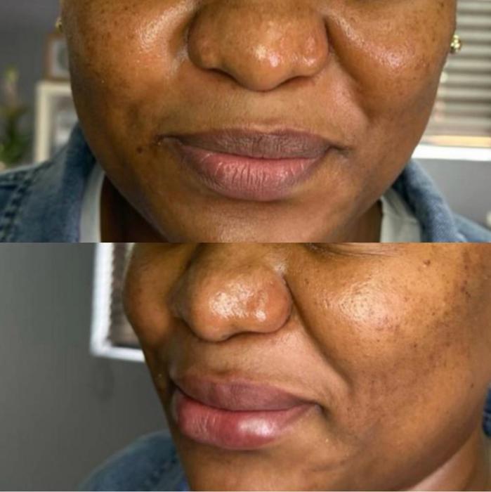 lip filler699