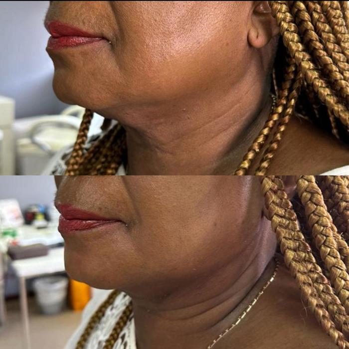 thread lift Lower face
